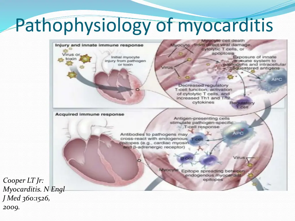 pathophysiology of myocarditis