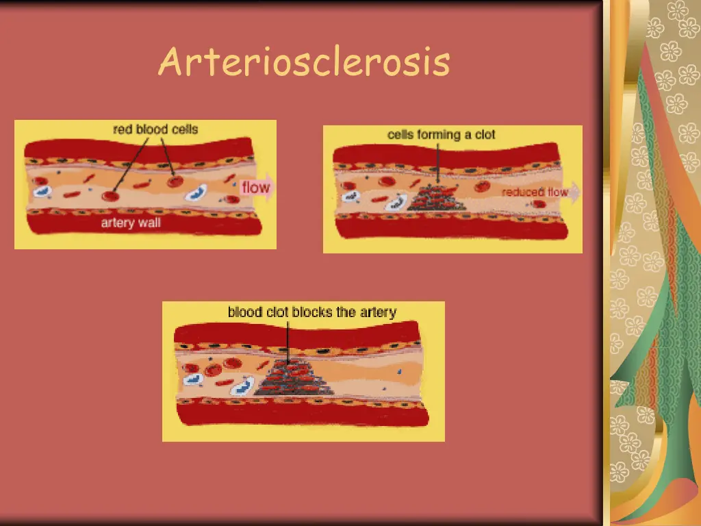 arteriosclerosis