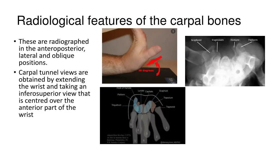 radiological features of the carpal bones