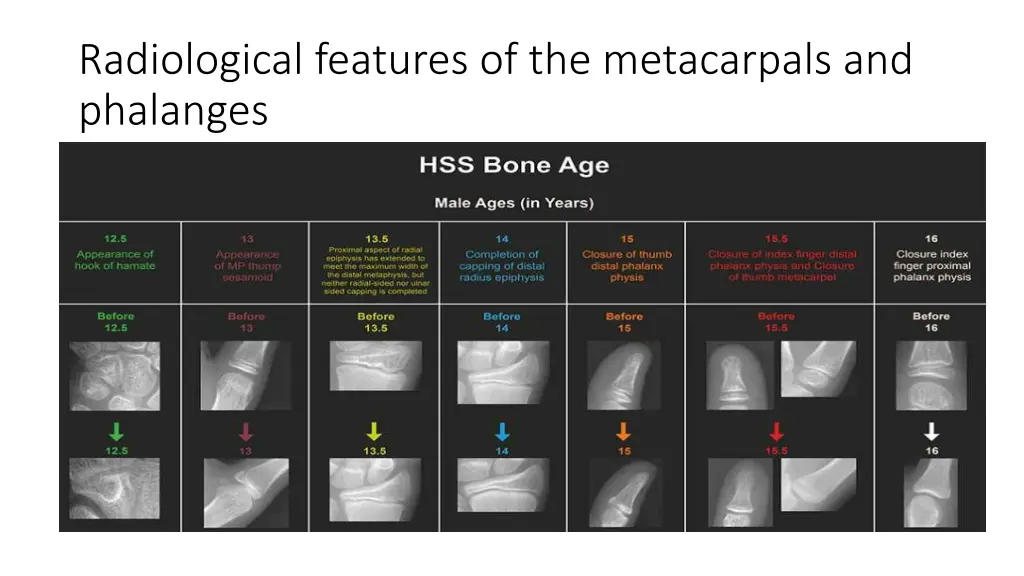 radiological features of the metacarpals