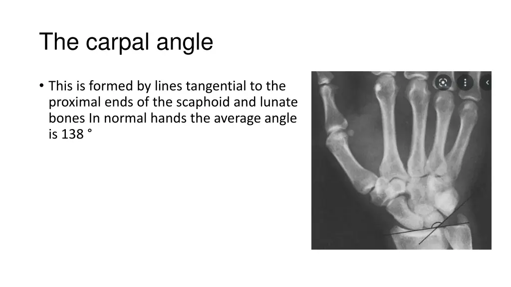 the carpal angle