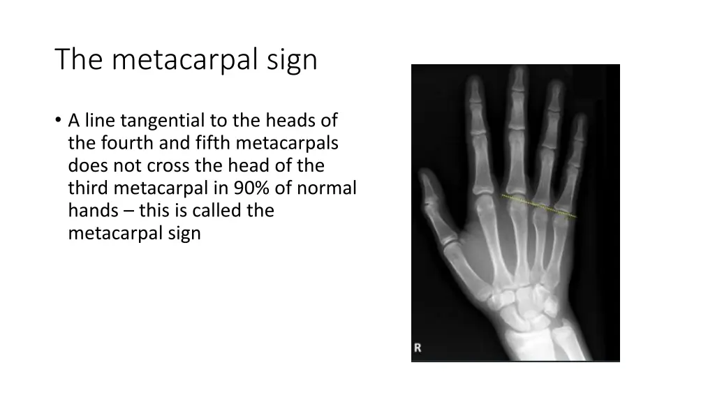 the metacarpal sign