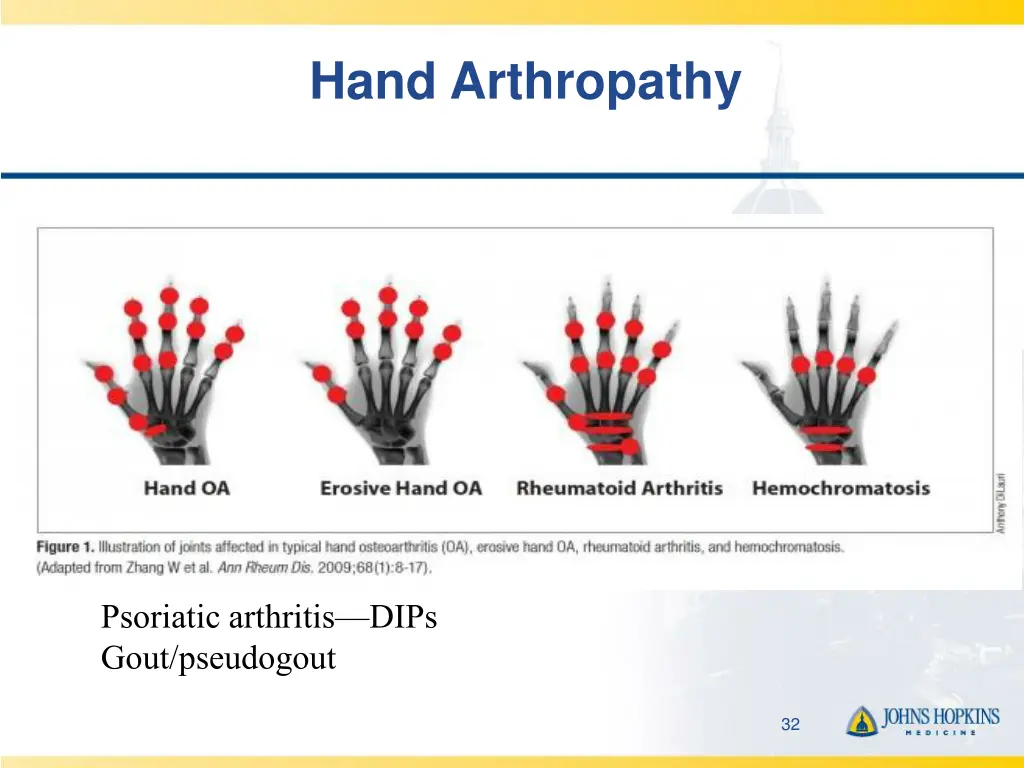 hand arthropathy