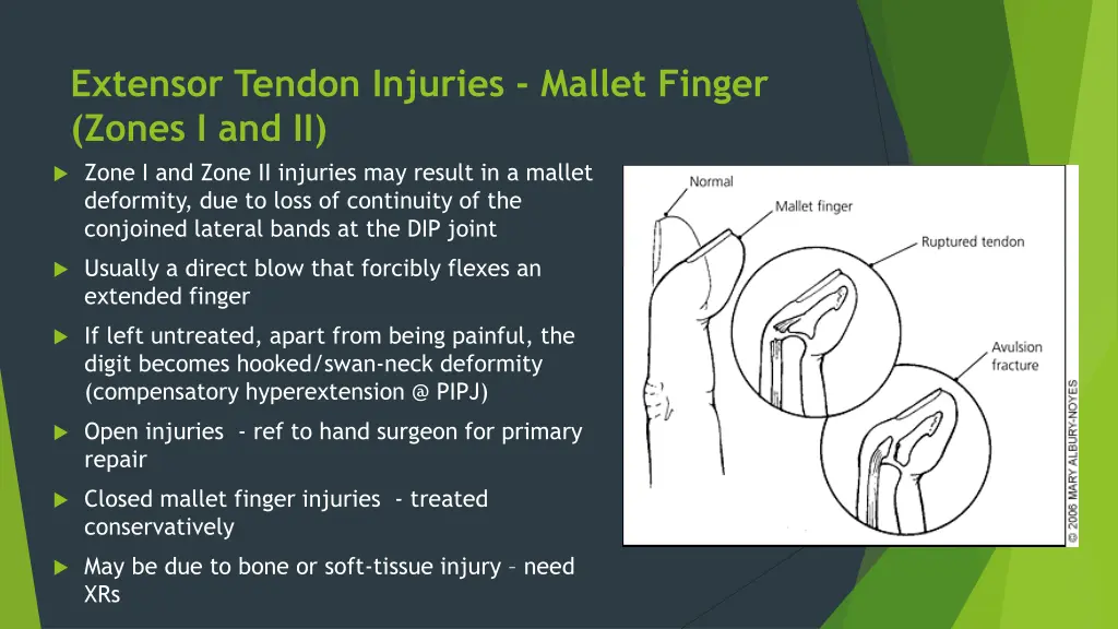 extensor tendon injuries mallet finger zones