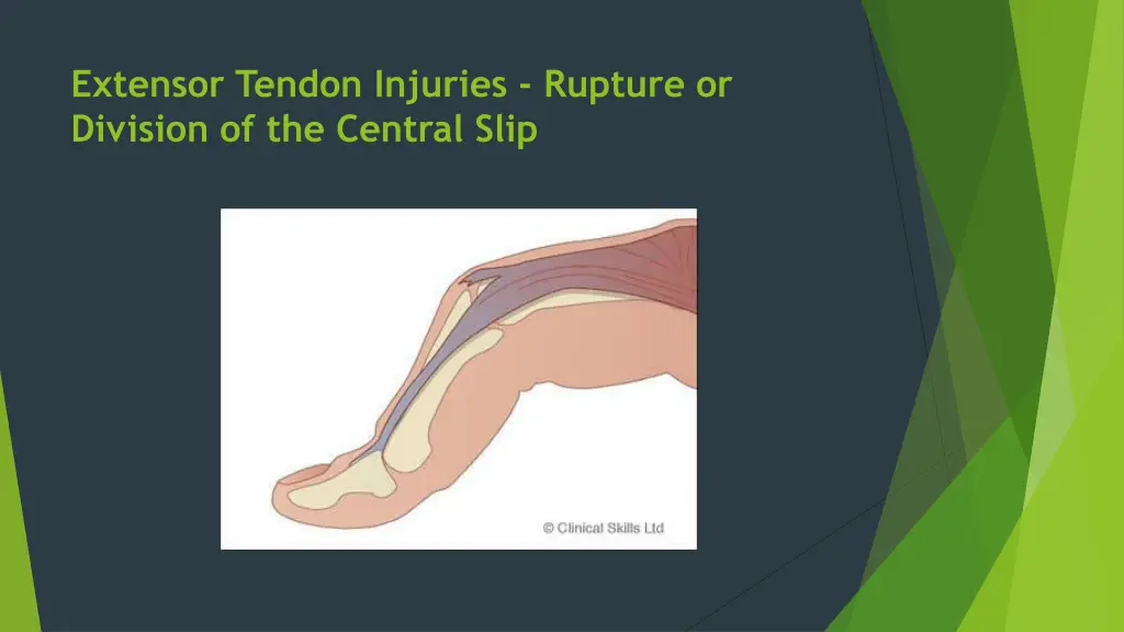 extensor tendon injuries rupture or division