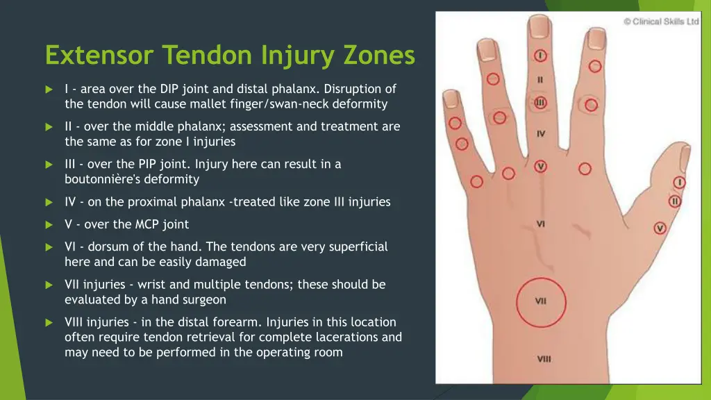 extensor tendon injury zones 1