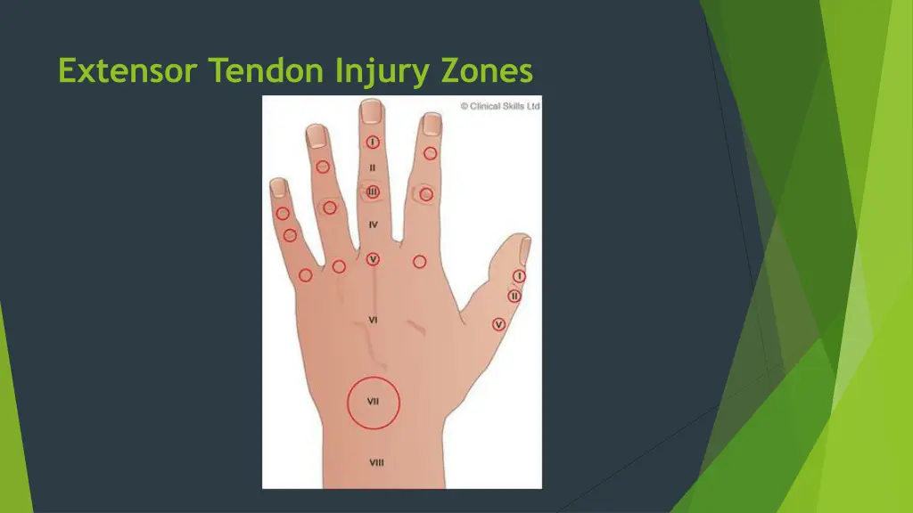 extensor tendon injury zones