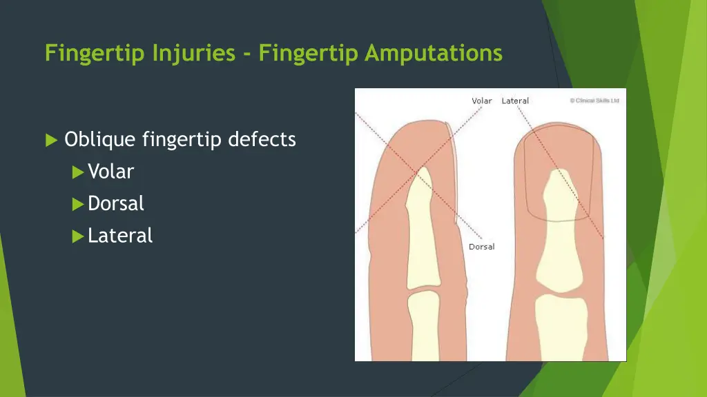 fingertip injuries fingertip amputations 1