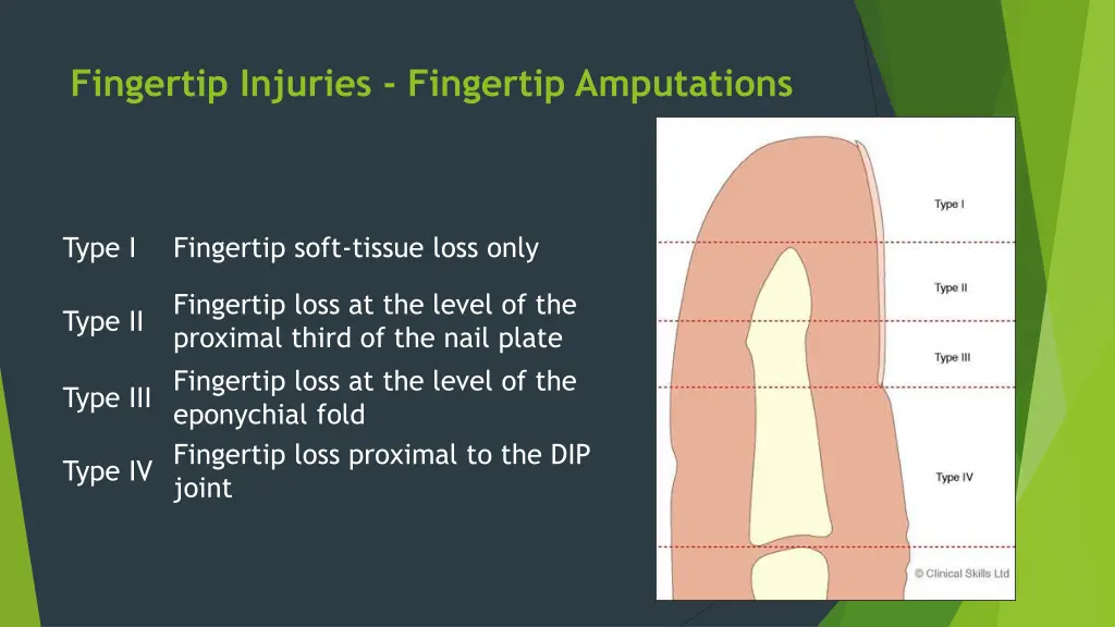 fingertip injuries fingertip amputations