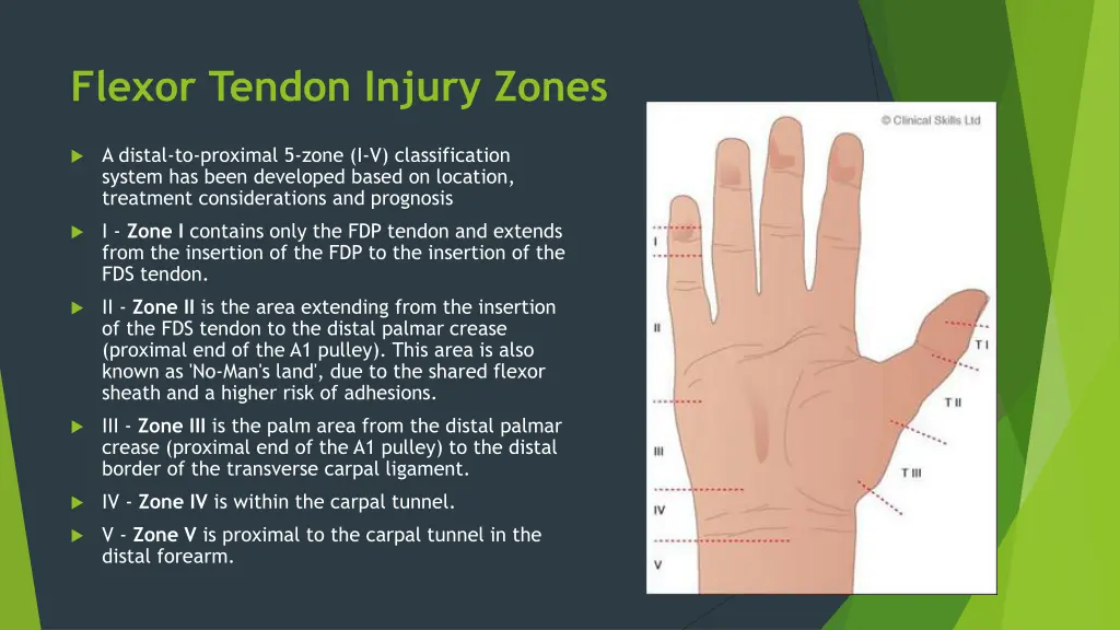 flexor tendon injury zones 1