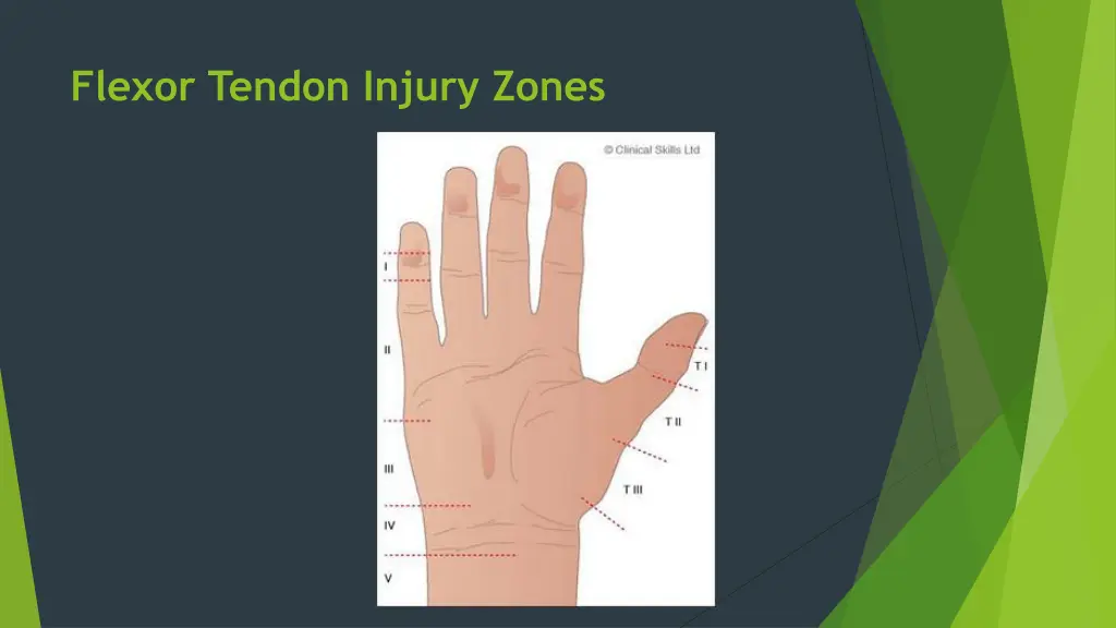 flexor tendon injury zones