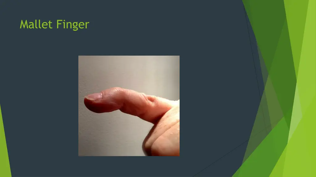 mallet finger