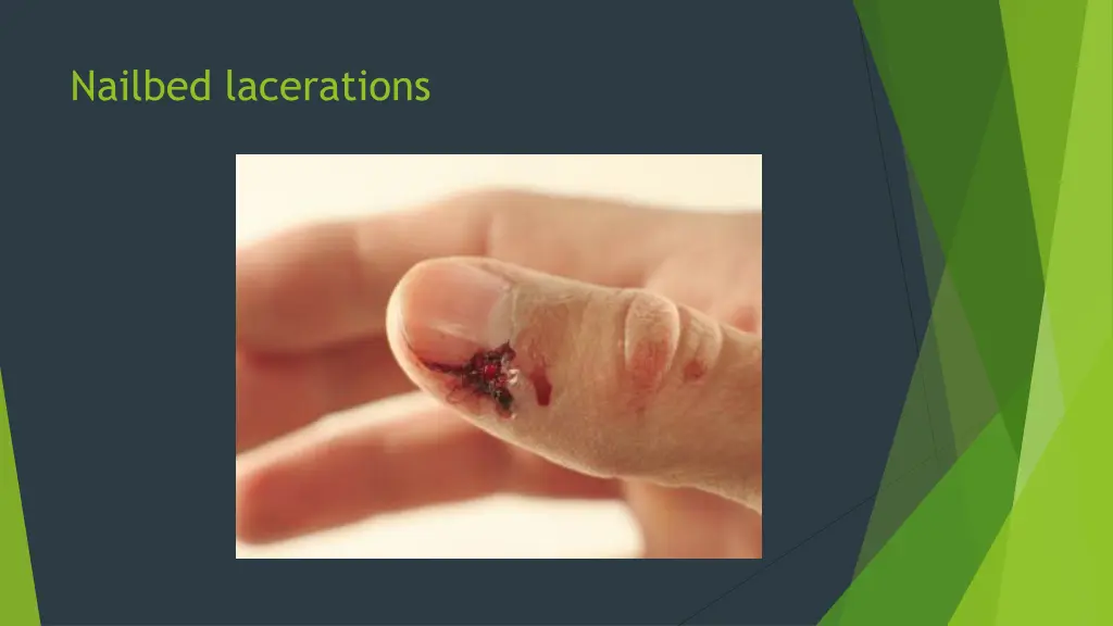 nailbed lacerations