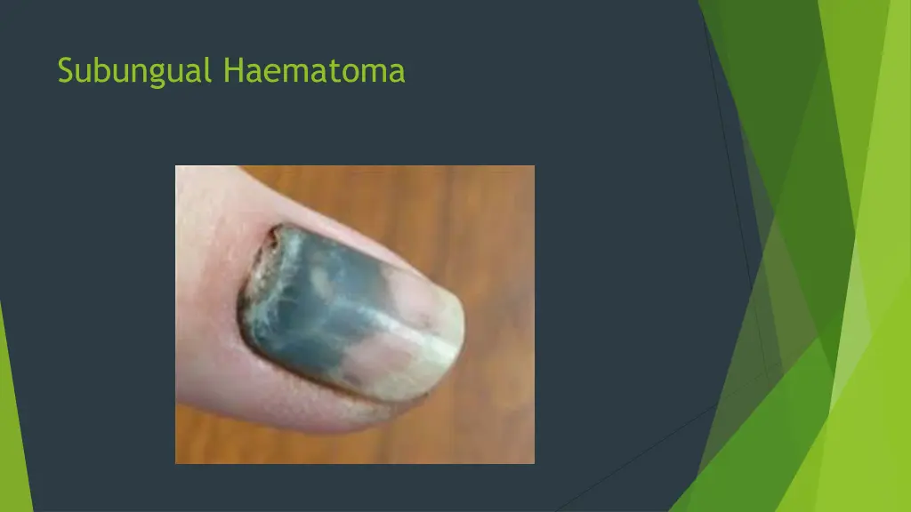 subungual haematoma