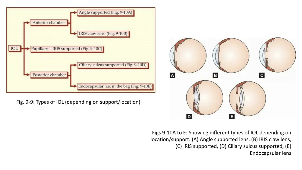 fig 9 9 types of iol depending on support location