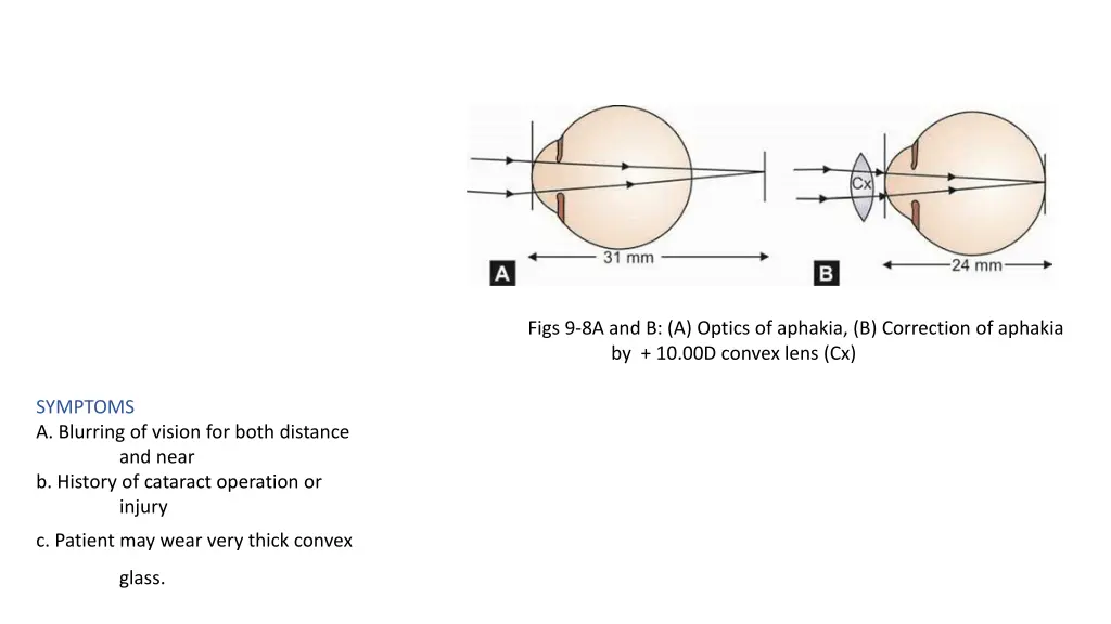 figs 9 8a and b a optics of aphakia b correction