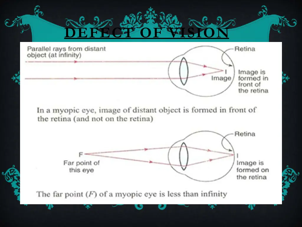 defect of vision 2