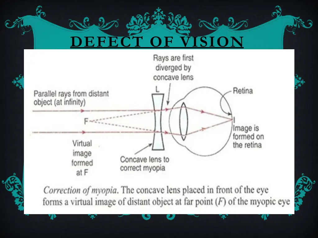 defect of vision 3