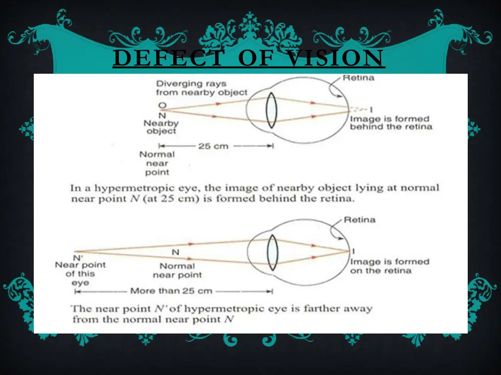 defect of vision 5