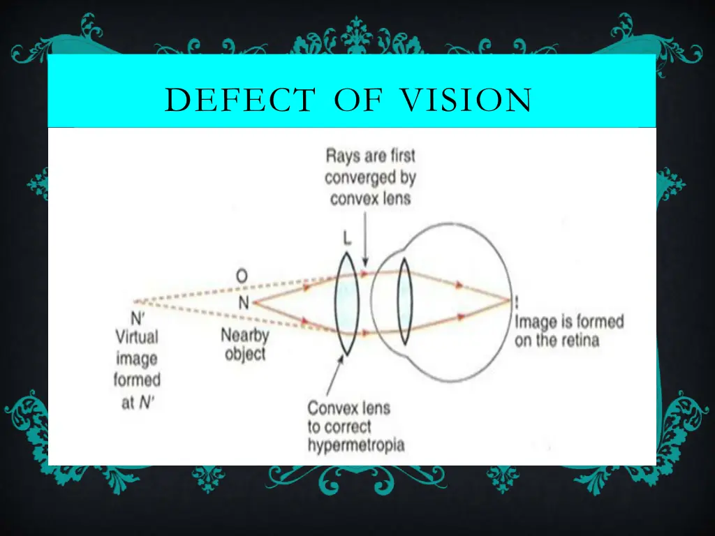 defect of vision 7