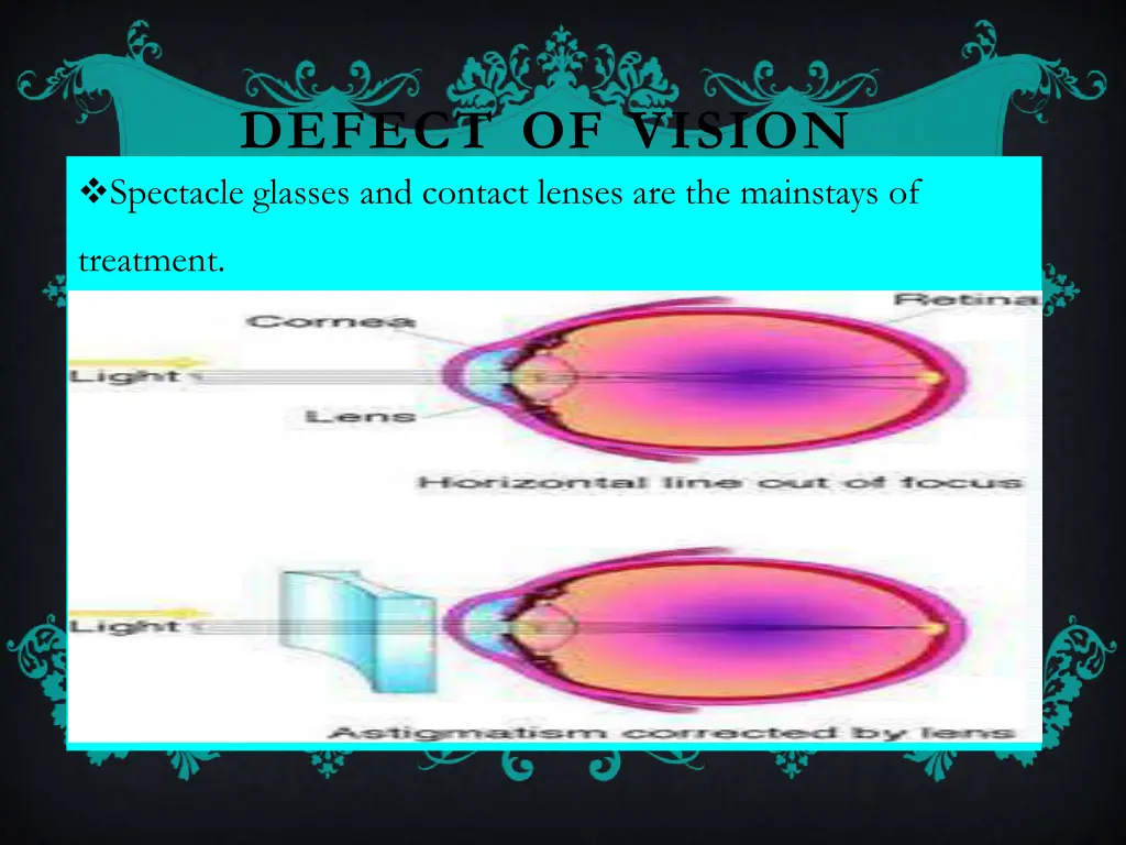 defect of vision spectacle glasses and contact