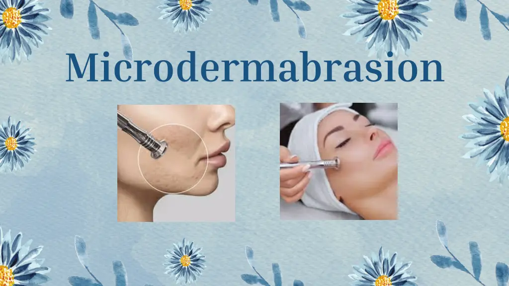 microdermabrasion 2