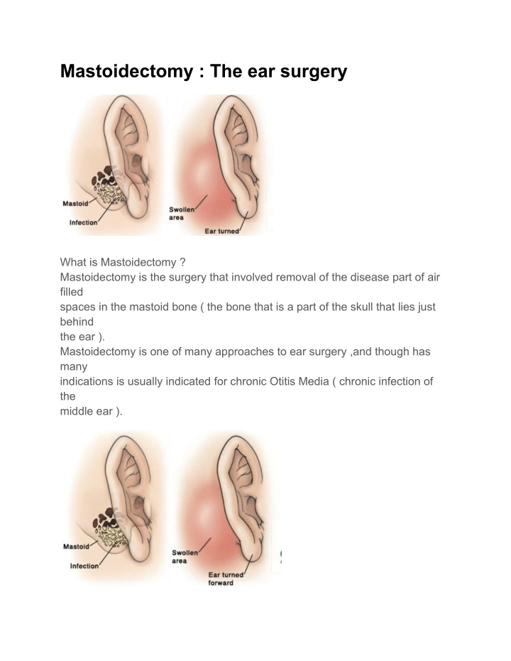 mastoidectomy the ear surgery