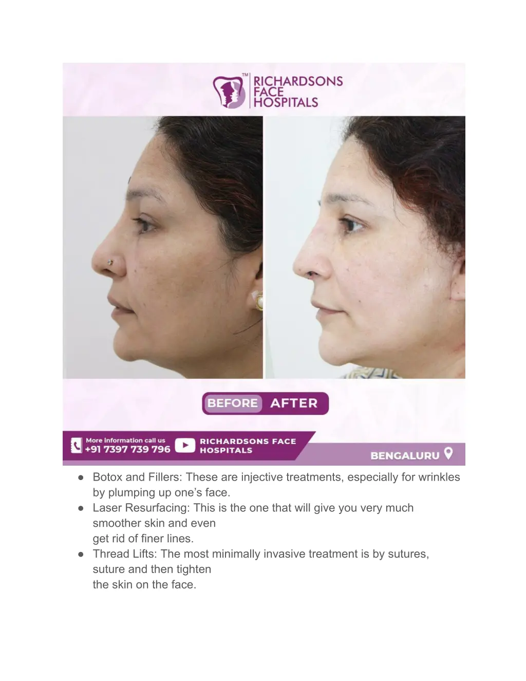 botox and fillers these are injective treatments