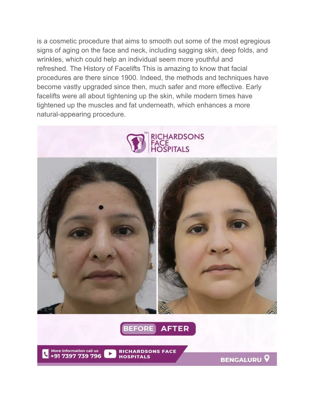 is a cosmetic procedure that aims to smooth