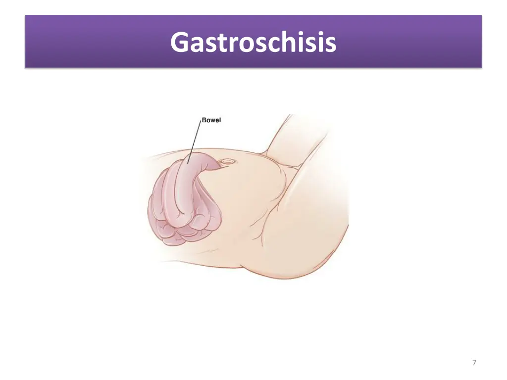 gastroschisis 2
