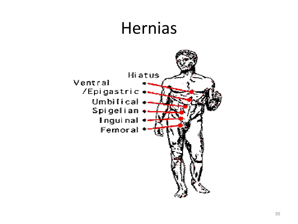 hernias 1