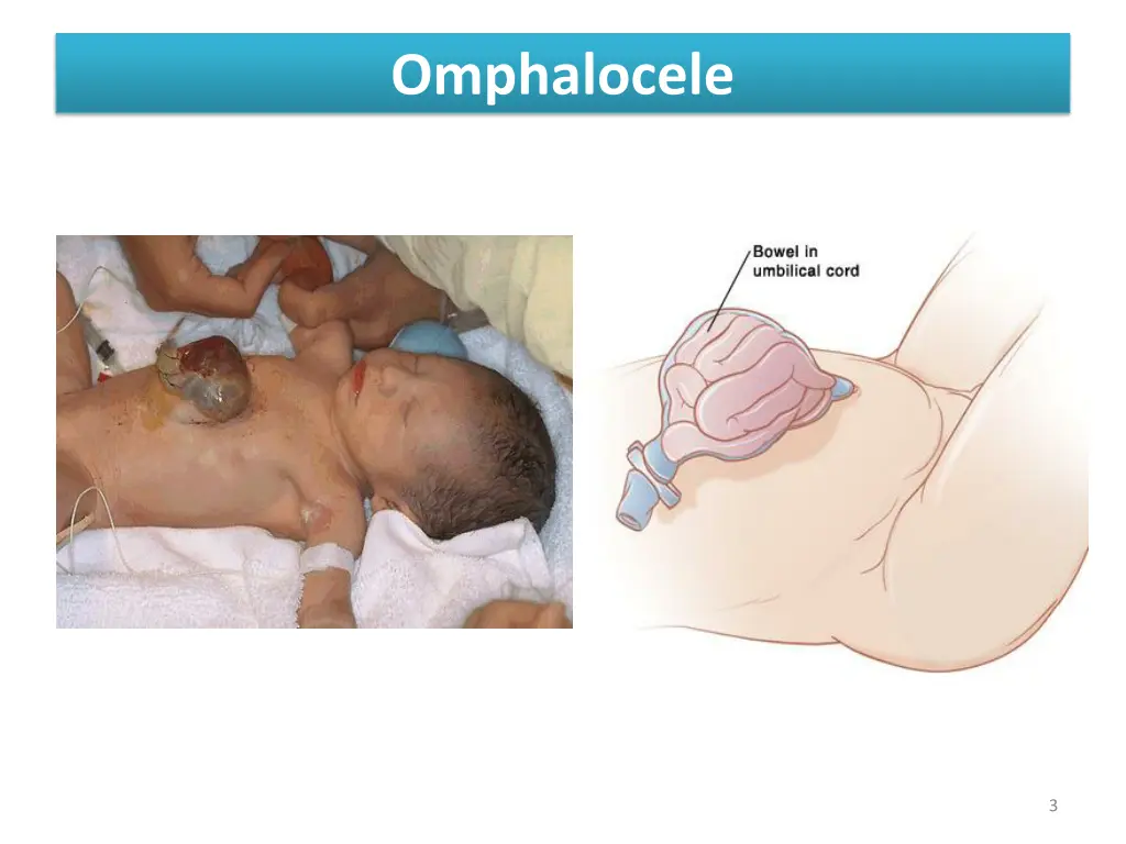 omphalocele 1