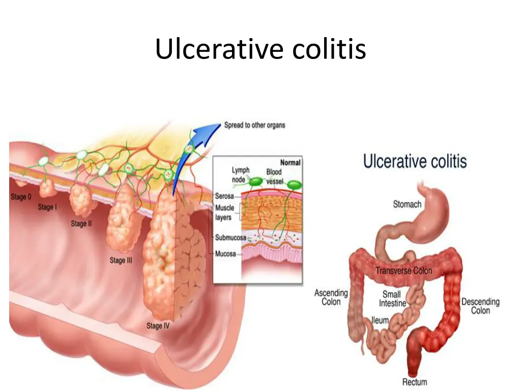 ulcerative colitis