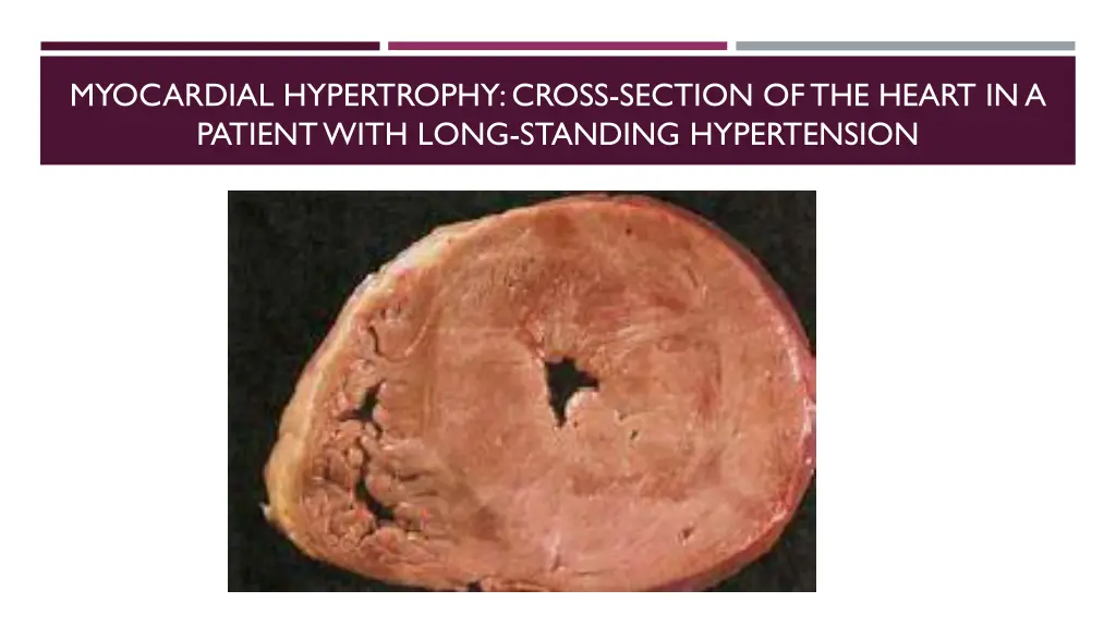 myocardial hypertrophy cross section of the heart