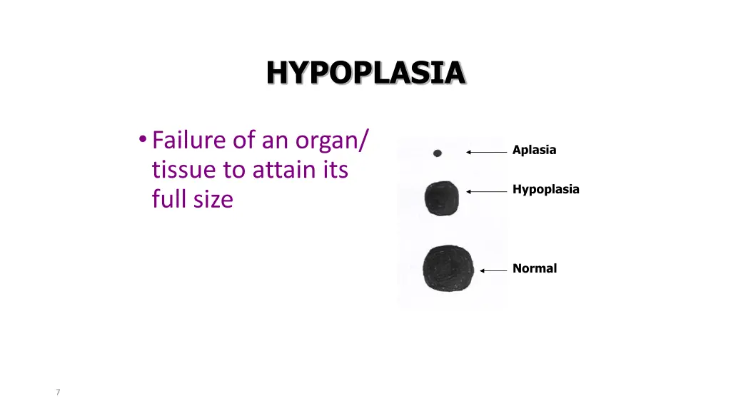 hypoplasia