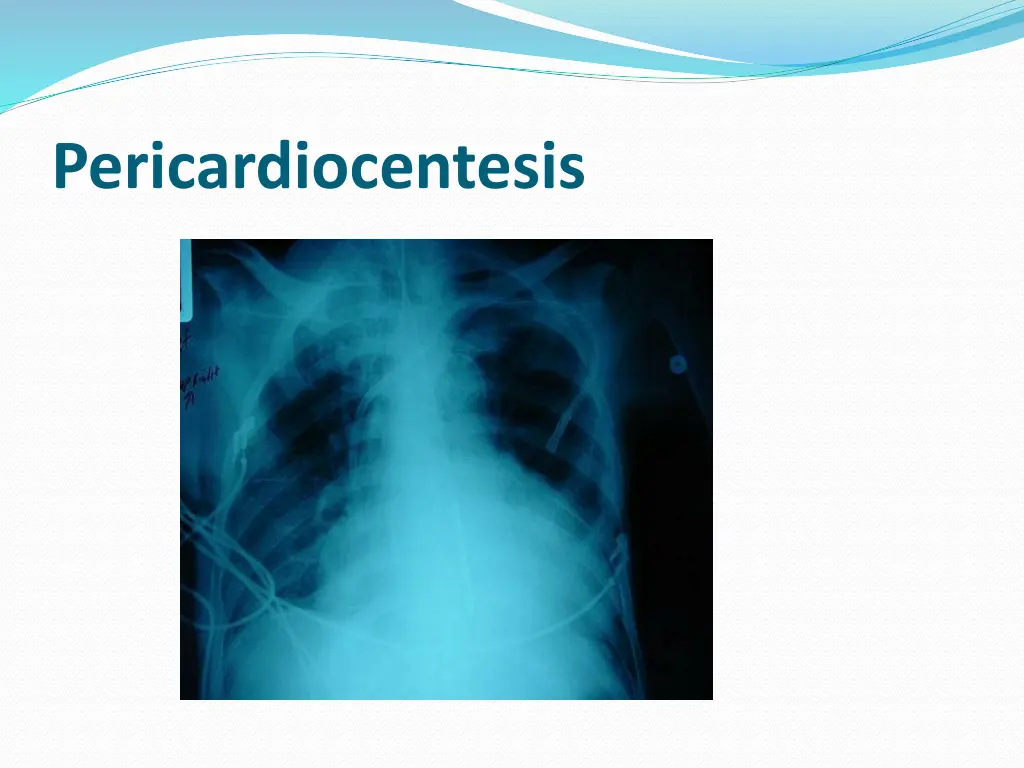 pericardiocentesis