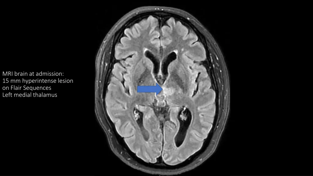 mri brain at admission 15 mm hyperintense lesion
