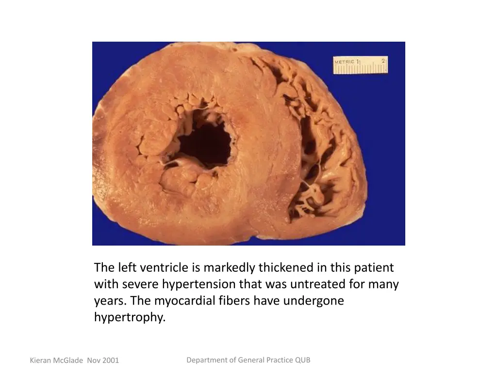 the left ventricle is markedly thickened in this