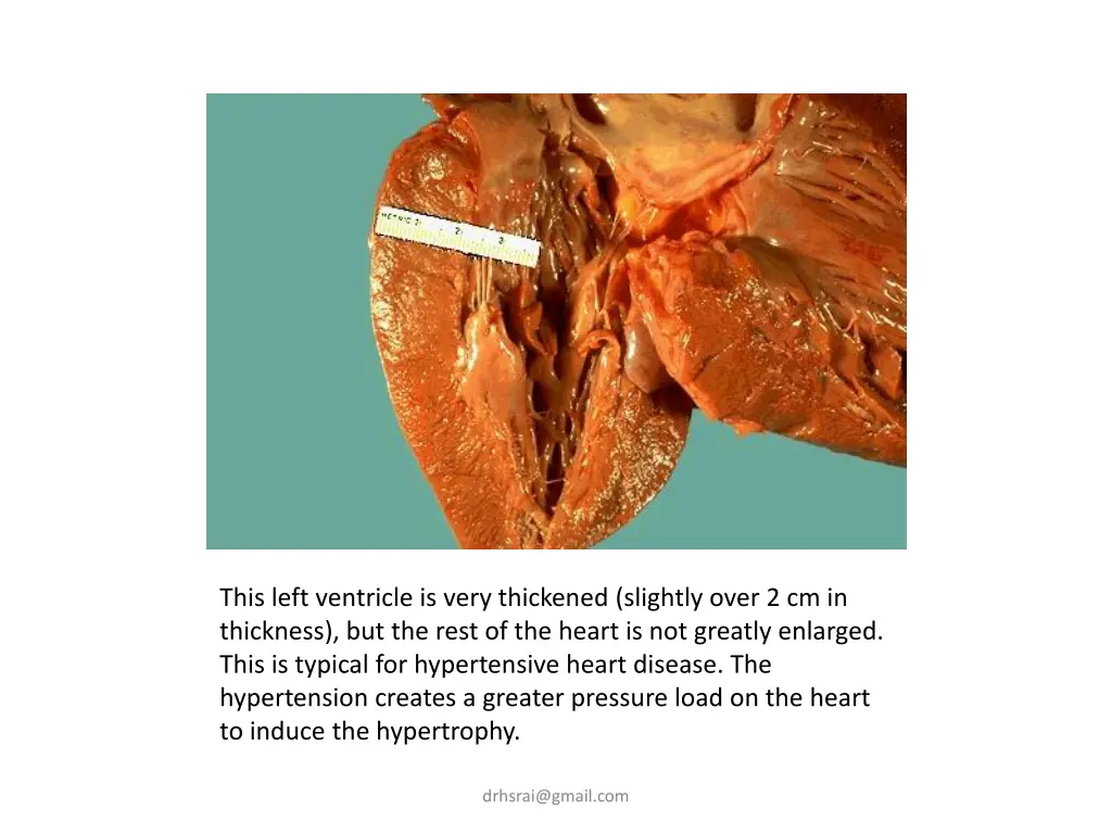 this left ventricle is very thickened slightly