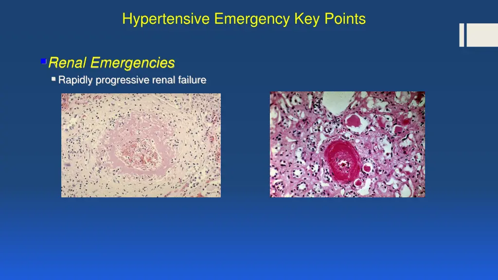 hypertensive emergency key points 1