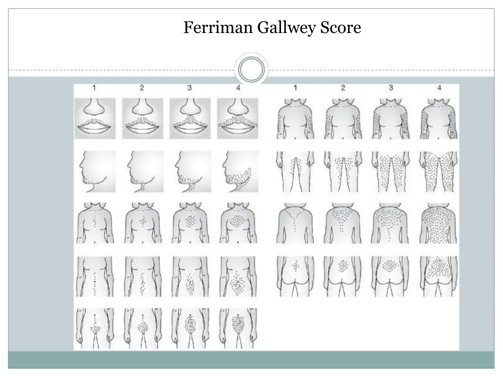 ferriman gallwey score