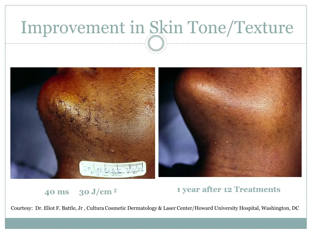 improvement in skin tone texture