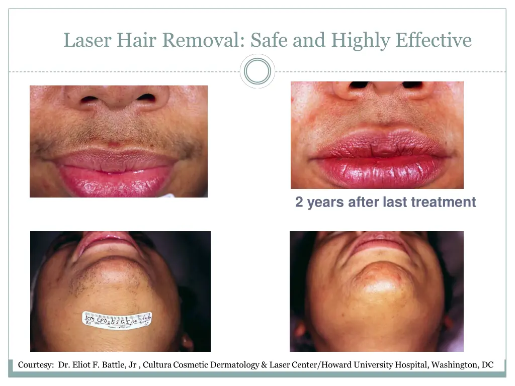 laser hair removal safe and highly effective