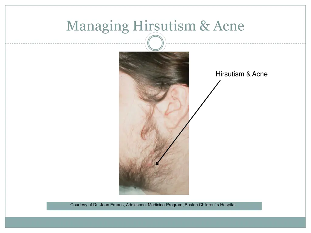 managing hirsutism acne