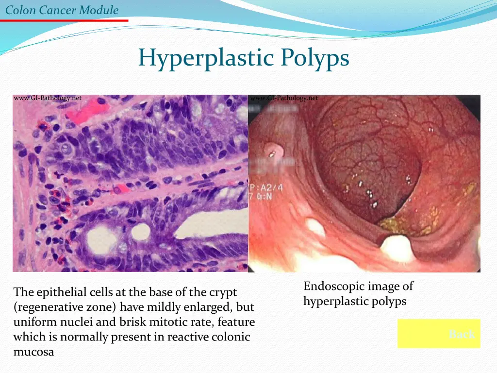 colon cancer module 1