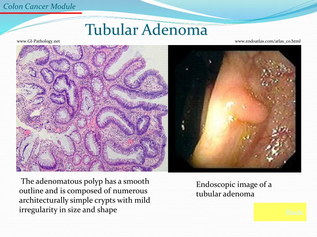 colon cancer module 2