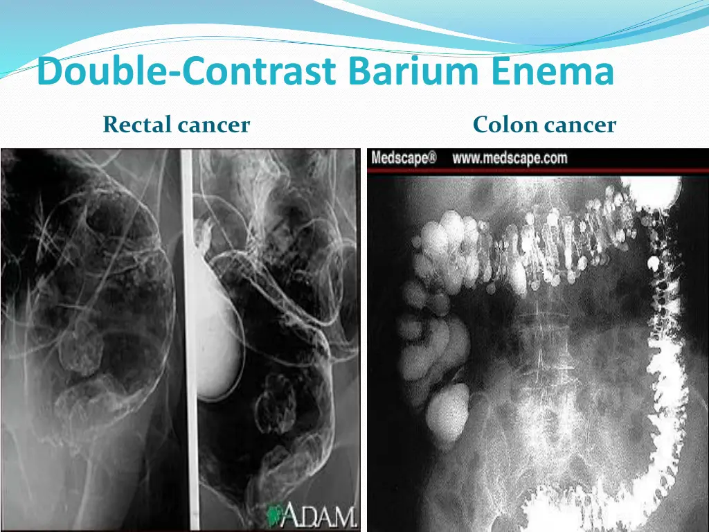 double contrast barium enema 1
