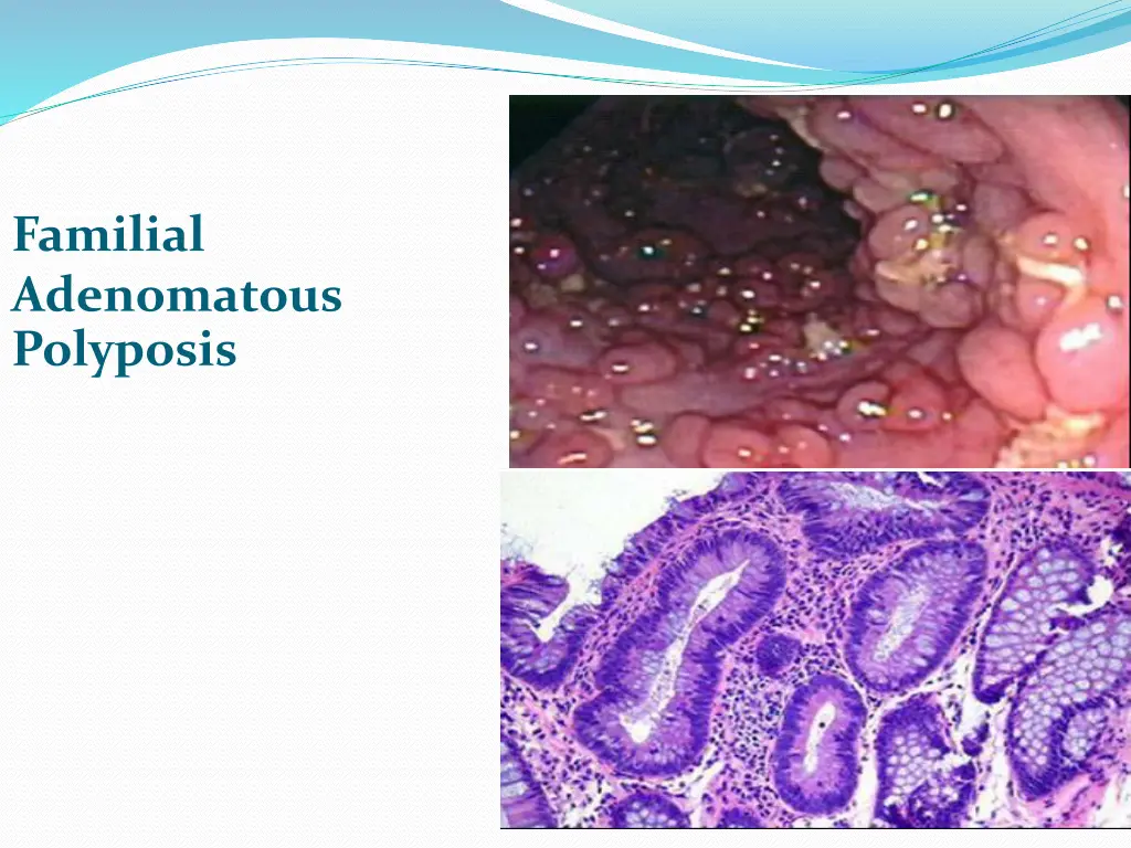 familial adenomatous polyposis