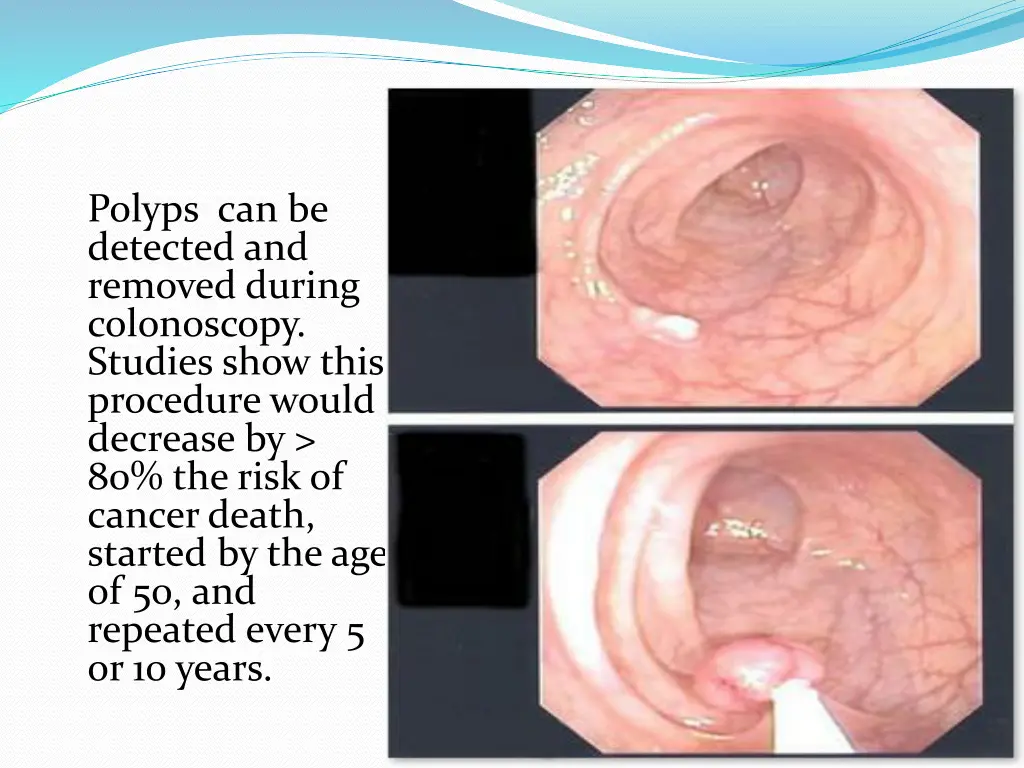 polyps can be detected and removed during