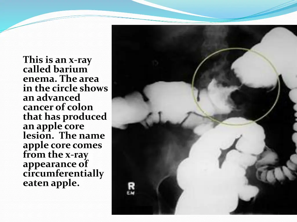 this is an x ray called barium enema the area